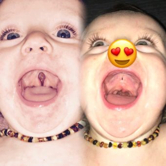cleft lip and palate before and after