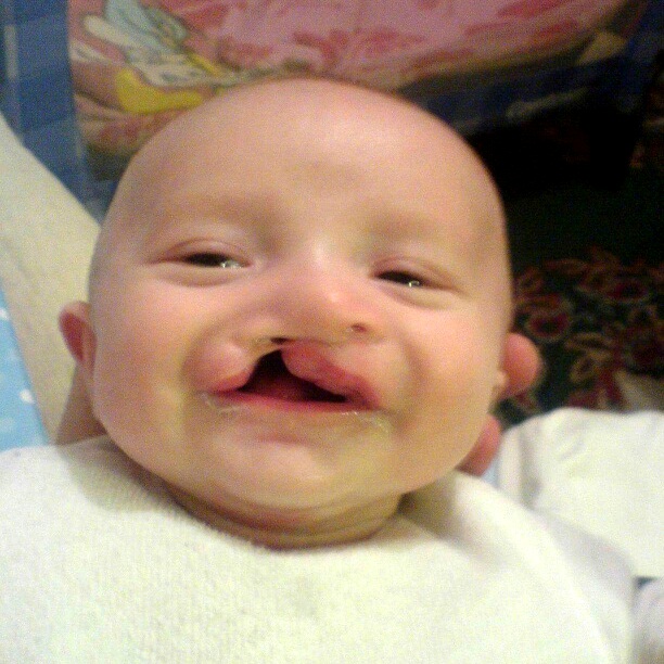 Alfie as a young baby before his cleft repair