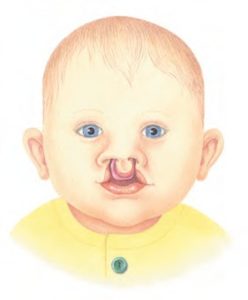 A bilateral cleft lip