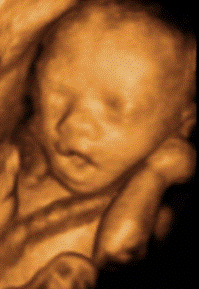 cleft palate 3d ultrasound