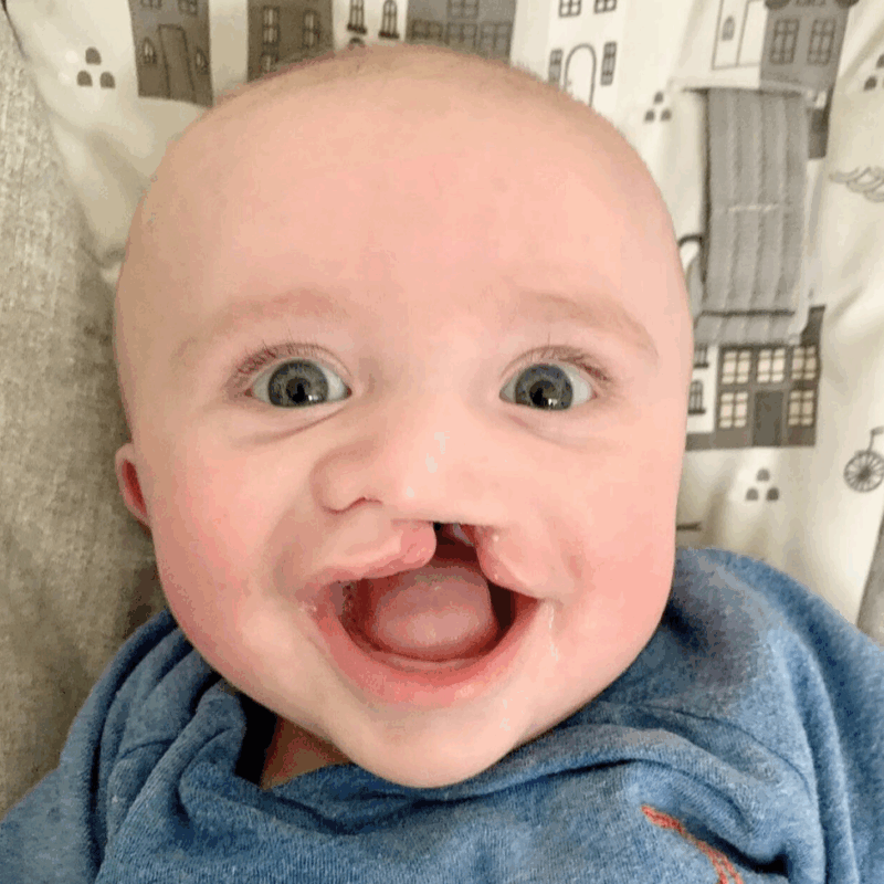 A unilateral (one-sided) cleft lip