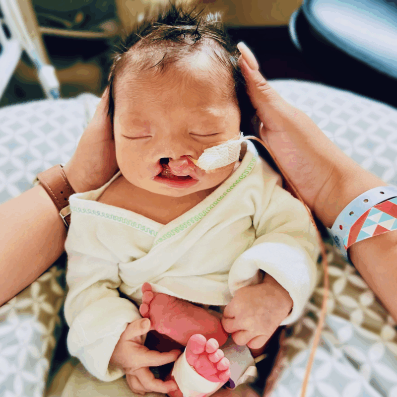 A cleft lip and palate with a feeding tube