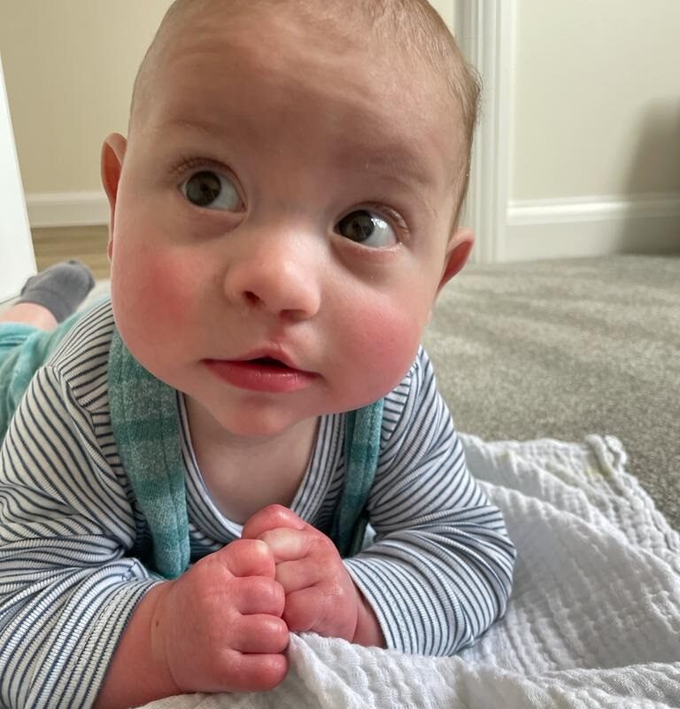 Daniel after his lip repair operation