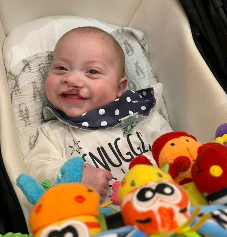 Daniel before his lip repair operation