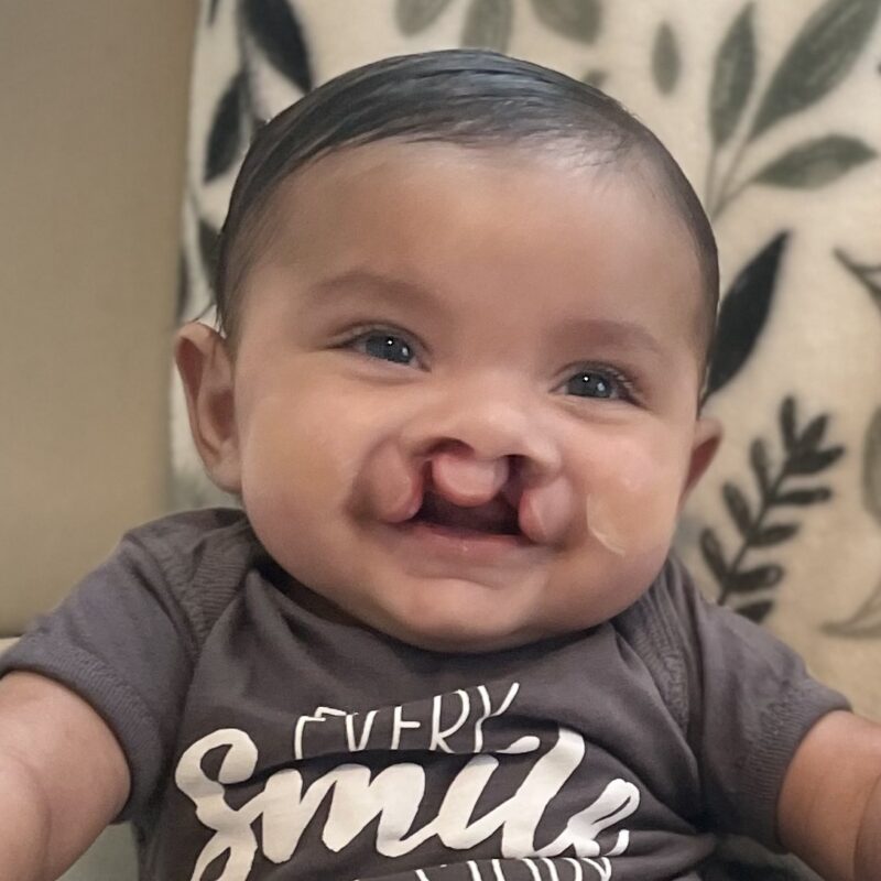 A bilateral (two-sided) cleft lip