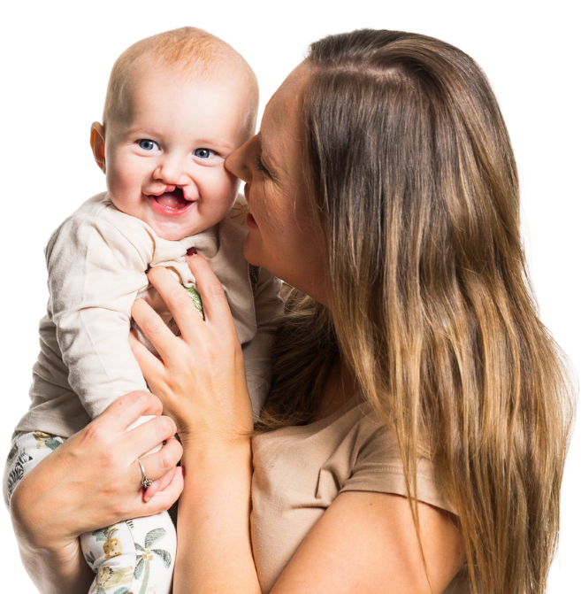 A mother and a baby are cuddling. The baby has an unrepaired cleft lip and is smiling